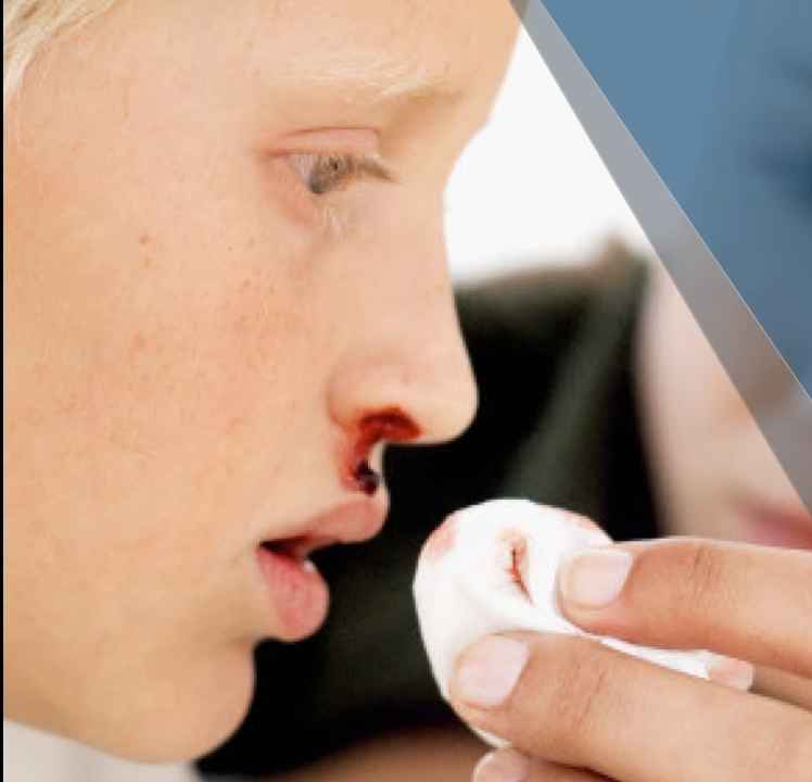 Shocking Truth Can Air Conditioners Cause Nosebleeds?